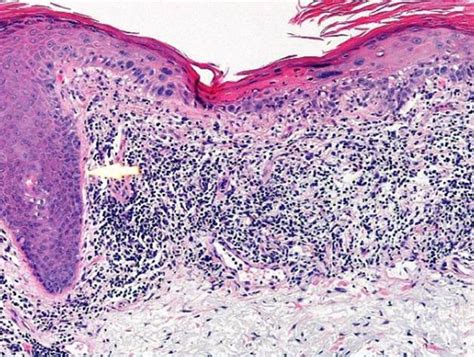 View 11 Bowenoid Actinic Keratosis Histology - wishquotearea