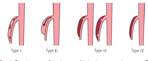 Figure 1 From The Classification And Management Strategy Of Spontaneous