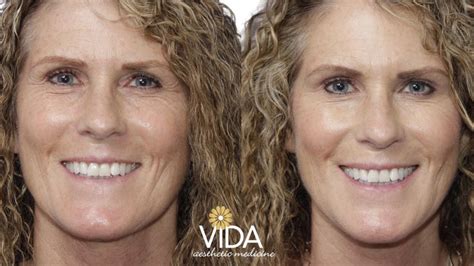 Injectables Photos Vida Aesthetic Medicine Salem Oregon