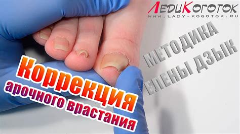 ВРОСШИЙ НОГОТЬ, АРОЧНАЯ ФОРМА, КАК ВЫЛЕЧИТЬ, [Методика Елены Дзык ...