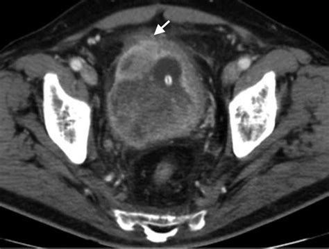 Imaging Of Urinary Diversion And Neobladder Radiology Key