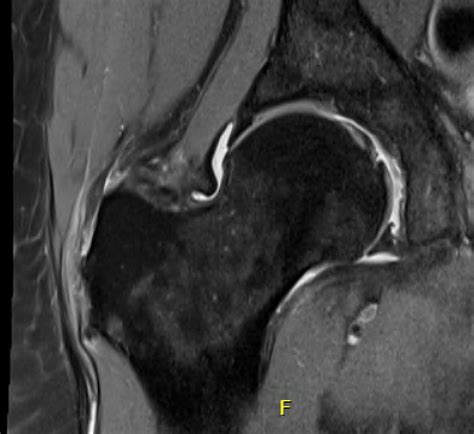 Abductor Tendon Tears The Bone School