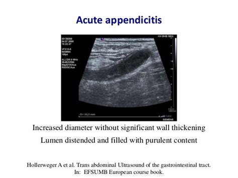 Acute appendicitis - Ultrasound first