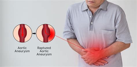 Understanding Aortic Aneurysm: Symptoms, Causes & Treatments