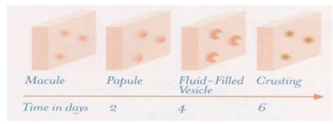 Chickenpox Flashcards Quizlet