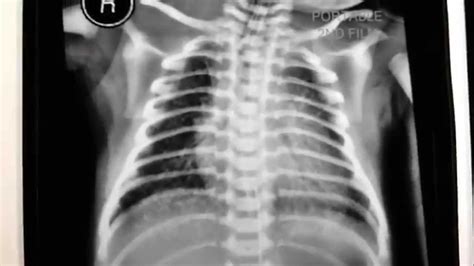 Rds X Ray In Newborn Respiratory Distress Syndrome Radiology Reference Article Radiopaedia Org