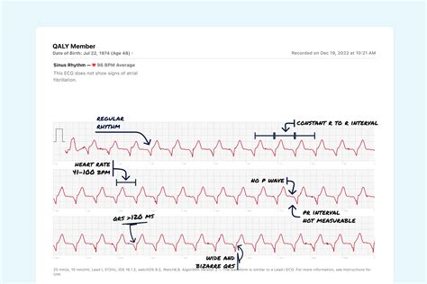 Accelerated Idioventricular Rhythm Vs. Premature Ventricular Contraction (Couplet) on Your Watch ...