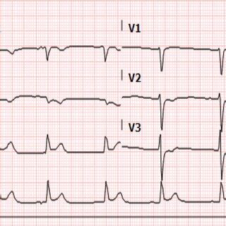 Twelve Lead Electrocardiogram Ecg Showing Acute Inferior St Elevation