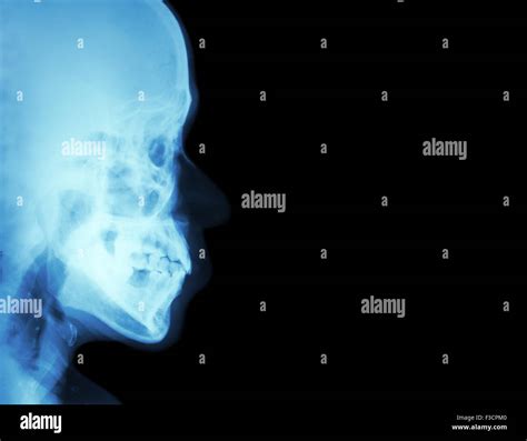 Film X Ray Lateral Nasal Bone Side View Of Skull And Blank Area At