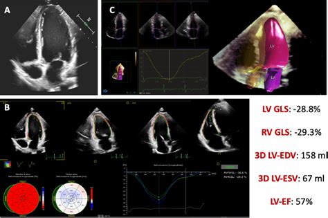 Echocardiographic Findings Transthoracic Echocardiography Showed