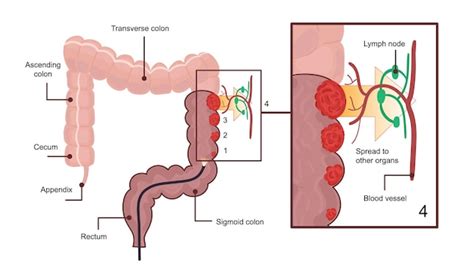 Premium Vector | Medical diagram of colon cancer scheme