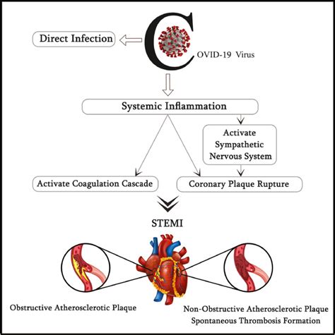 A Review Of Coronary Artery Thrombosis A New Challenging Finding In