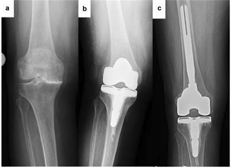 Early Femoral Insufficiency Fractures After Primary Total Knee