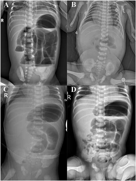 Frontiers Meconium Peritonitis Intestinal Atresia Combined With