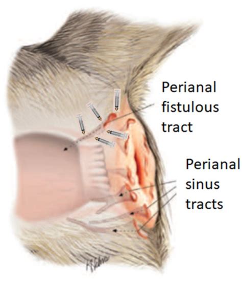 Fistula Homeopathy Treatment 4
