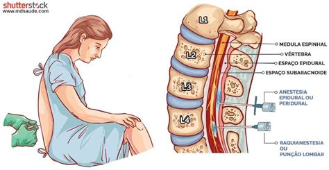 Anestesia Raqui Efeitos Colaterais A Longo Prazo - Raquianestesia: o que é, efeitos colaterais e anatomia