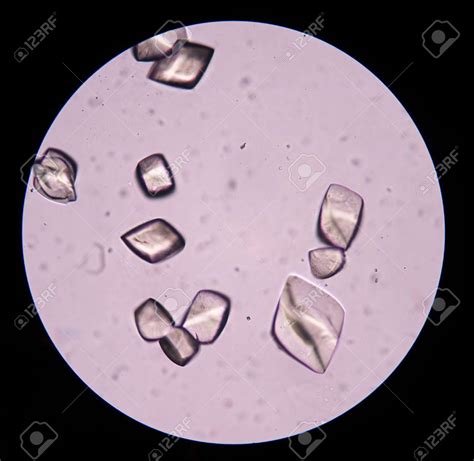 Detail Gambar Uric Acid Dalam Sedimen Urin Koleksi Nomer 5