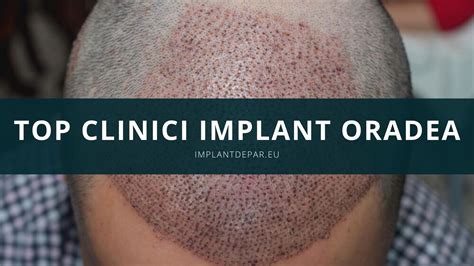 Implant De Par Turcia Top Clinici Testate In