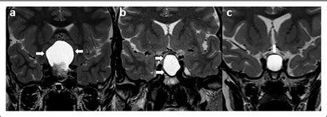 Figure 4 From Differentiation Of Pure Cystic Sellar Lesions On Magnetic