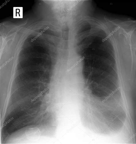 X-ray lung. showing a large infiltrate in the left lung, Pleurisy ...