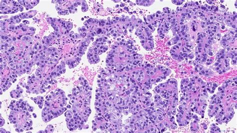 Clear Cell Carcinoma Of The Uterus Ottawa Atlas Of Pathology