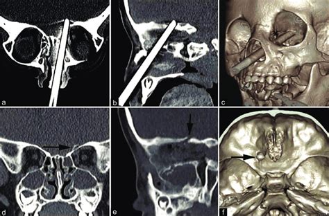 Penetration Of A Metallic Foreign Body Into The Left Ethmoidal Sinus To