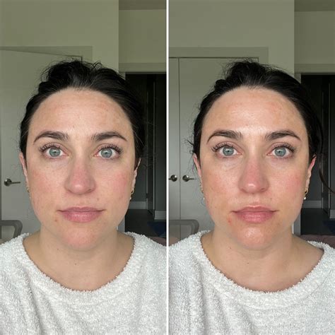 Ziip Device Results And Review Ivy Boyd Makeup