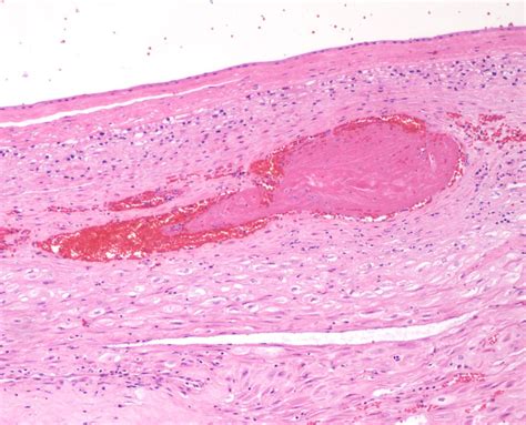 Chapter Placental Perfusion Section A Spiral Arteries Obstetrical