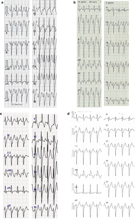 Twelve Lead Electrocardiogram Of Recorded VT In Four Patients RBBB