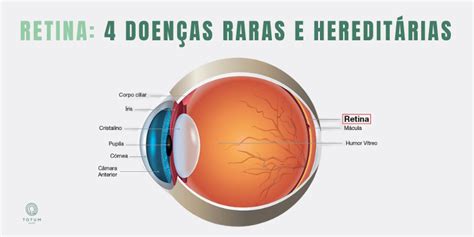 Retina Doen As Heredit Rias E Raras Totum