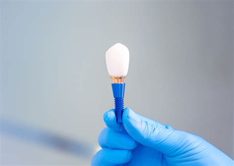 Understanding Abutment Implants An In Depth Guide To Dental Implants