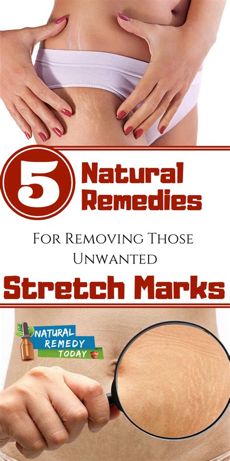 Take Care Of Your Skin With These Simple Steps Stretch Marks Stretch Mark Remedies Stretch