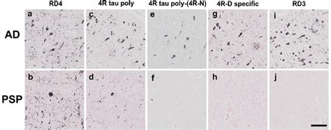 Difference In Tau Immunoreactivity Between Ad And Psp Brains Bar 100