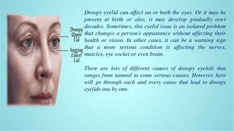 Causes and home remedies for droopy eyelids