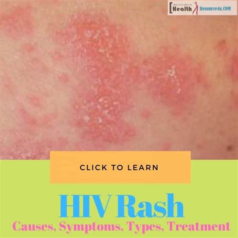 Hiv Rash Start