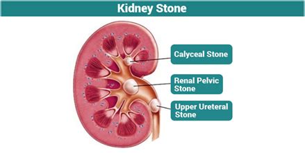 types  renal calculi