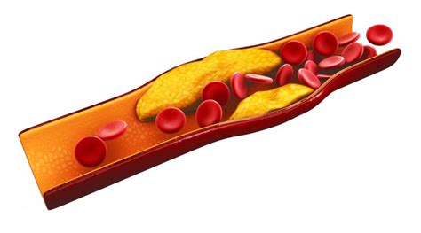 DISLIPIDEMIA Clínica Paias