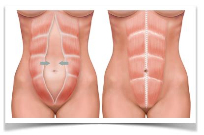 Healthy And Crafty Diastasis Abdominal Que Es Y Como Tratarla