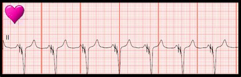 Float Nurse: Practice EKG Strips 437