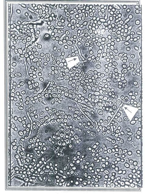 Germ Tube Production By Candida Albicans In Human Download Scientific Diagram