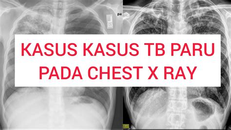 Kasus Kasus TB Paru Pada Foto Rontgen Thorax YouTube