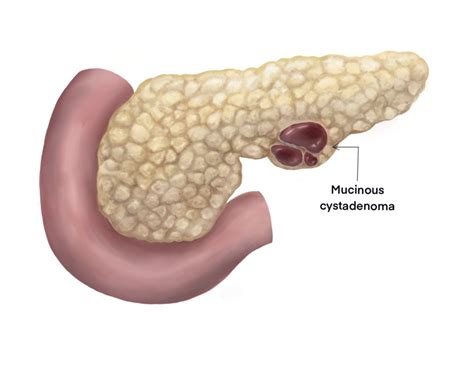 [figure Illustration Of Mucinous Cystadenoma Illustrated By Callahan