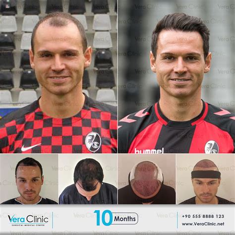 Vera Clinic The Best Hair Transplant Doctors In Turkey More Than