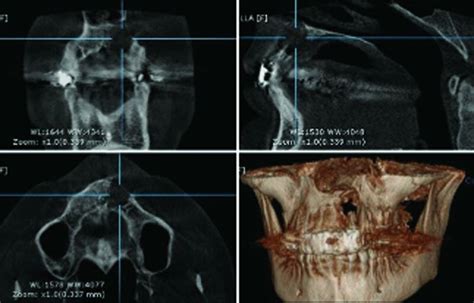 Preoperative Computed Tomography Scan Download Scientific Diagram