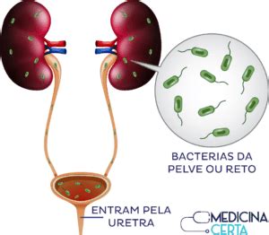 Tudo Sobre Infec O Urin Ria Sintomas Diagnostico Medicinacerta