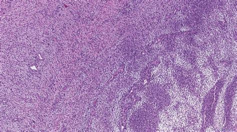 Malignant Peripheral Nerve Sheath Tumour Atlas Of Pathology