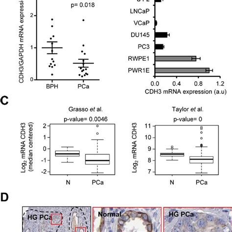 cdh expression  reduced  pca specimens  cdh expression