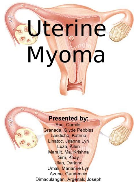 Myoma Case | PDF | Uterus | Estrogen