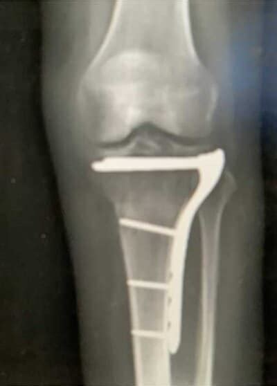 Tibial Plateau Fracture X Ray