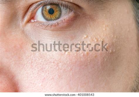 Milia Milium Pimples Around Eye On Stock Photo (Edit Now) 401008543